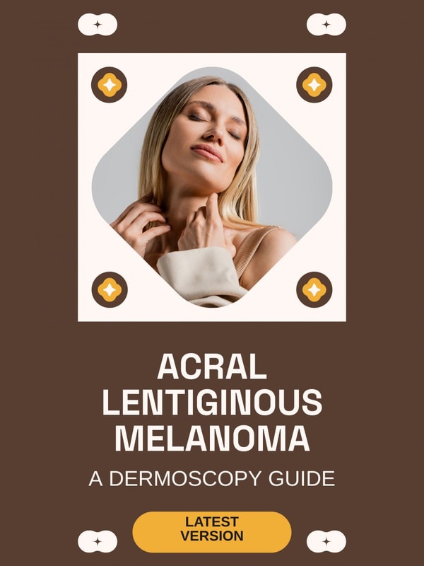 Acral Lentiginous Melanoma